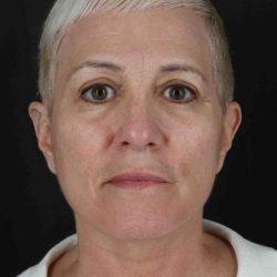 My Houston Surgeons blepharoplasty after — Houston, TX