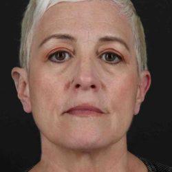 Blepharoplasty before at My Houston Surgeons in Houston, TX