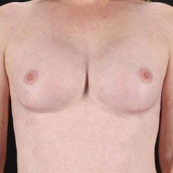 My Houston Surgeons breast augmentation after — Houston, TX