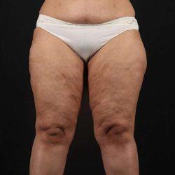 Thigh Lift before at My Houston Surgeons in Houston, TX