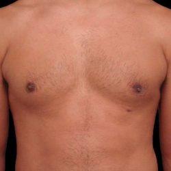 Gynecomastia Surgery after at My Houston Surgeons in Houston, TX