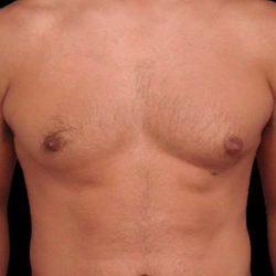 Gynecomastia Surgery before at My Houston Surgeons in Houston, TX