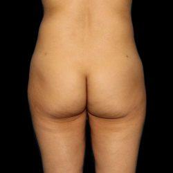 Brazilian Butt Lift before at My Houston Surgeons in Houston, TX