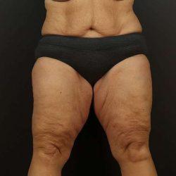 Thigh Lift before at My Houston Surgeons in Houston, TX