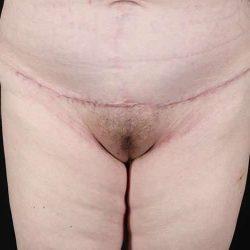 My Houston Surgeons tummy tuck after — Houston, TX