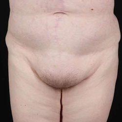 Mini Tummy Tuck before at My Houston Surgeons in Houston, TX