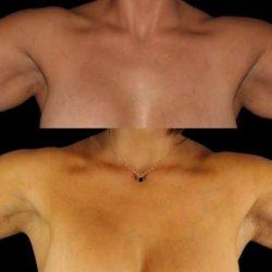 My Houston Surgeons arm lift result — Houston, TX