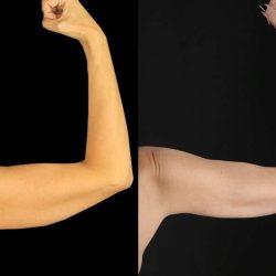 My Houston Surgeons arm lift result — Houston, TX