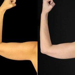 My Houston Surgeons arm lift result — Houston, TX