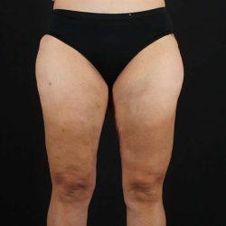 Liposuction after at My Houston Surgeons in Houston, TX