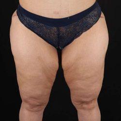 Liposuction before at My Houston Surgeons in Houston, TX