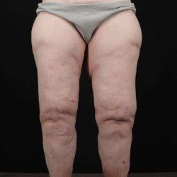 My Houston Surgeons thigh lift after — Houston, TX