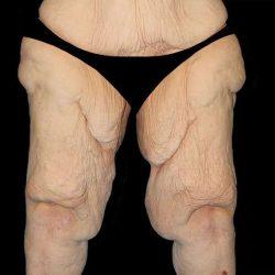 Thigh Lift before at My Houston Surgeons in Houston, TX