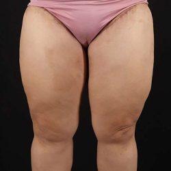 Thigh Lift after at My Houston Surgeons in Houston, TX