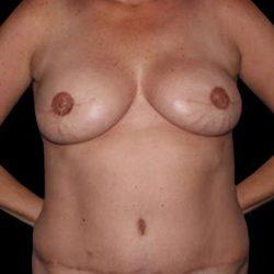 Mommy Makeover after at My Houston Surgeons in Houston, TX