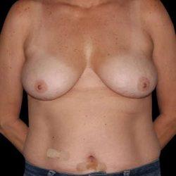 Mommy Makeover before at My Houston Surgeons in Houston, TX