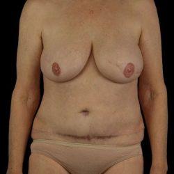 Mommy Makeover after at My Houston Surgeons in Houston, TX