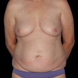 Mommy Makeover before at My Houston Surgeons in Houston, TX