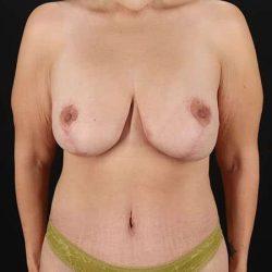 My Houston Surgeons mommy makeover after — Houston, TX