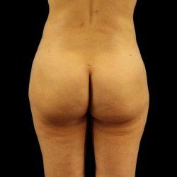 My Houston Surgeons bbl after — Houston, TX