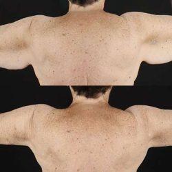 My Houston Surgeons arm lift result — Houston, TX