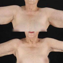 My Houston Surgeons arm lift result — Houston, TX