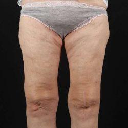 Thigh Lift after at My Houston Surgeons in Houston, TX