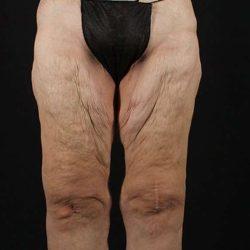 Thigh Lift before at My Houston Surgeons in Houston, TX