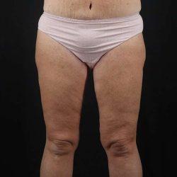 Thigh Lift after at My Houston Surgeons in Houston, TX