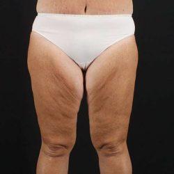 Thigh Lift before at My Houston Surgeons in Houston, TX