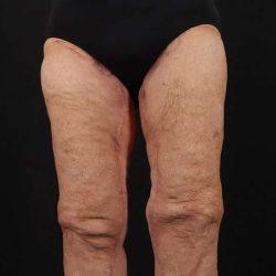Thigh Lift after at My Houston Surgeons in Houston, TX