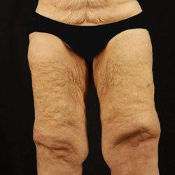 Thigh Lift before at My Houston Surgeons in Houston, TX