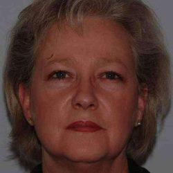 Facelift before at My Houston Surgeons in Houston, TX