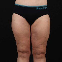 Thigh Lift after at My Houston Surgeons in Houston, TX