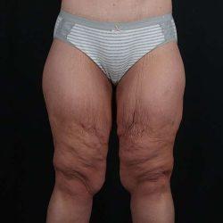 Thigh Lift before at My Houston Surgeons in Houston, TX