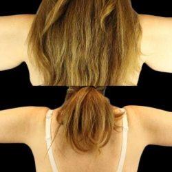 Arm Lift after at My Houston Surgeons in Houston, TX
