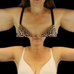 Arm Lift before at My Houston Surgeons in Houston, TX