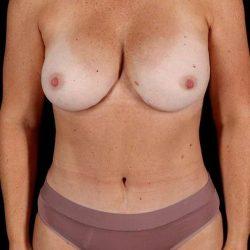 My Houston Surgeons breast augmentation after — Houston, TX