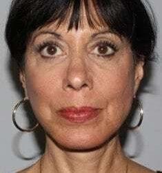 Facelift after at My Houston Surgeons in Houston, TX