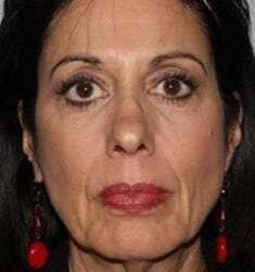Facelift before at My Houston Surgeons in Houston, TX