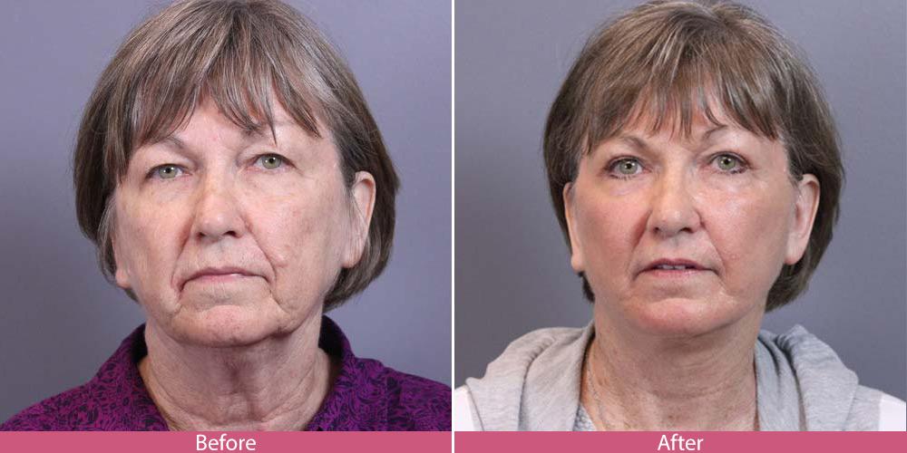Facial Beauty result — Seattle, WA