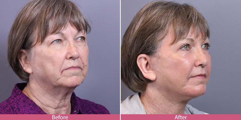 Facial Beauty result — Seattle, WA