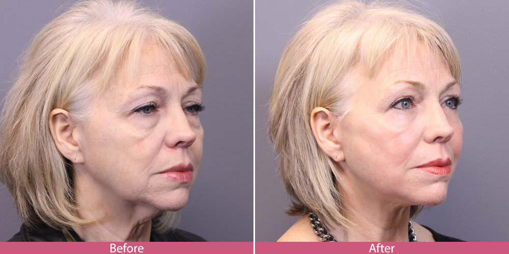 Facial Beauty result — Seattle, WA
