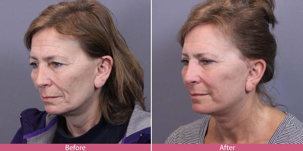 Facial Beauty result — Seattle, WA