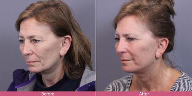 Deep Plane Facelift result at Facial Beauty in Seattle, WA