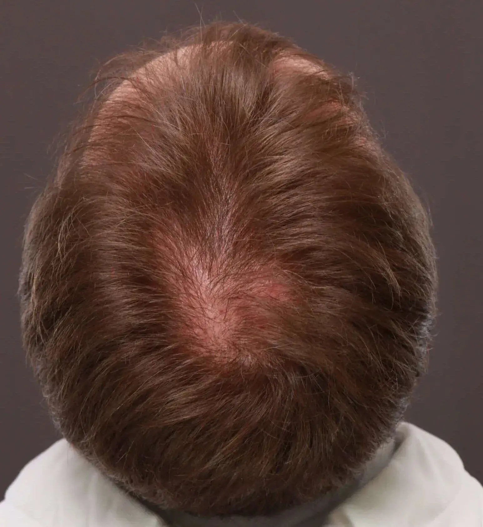 UFP Hair Restoration fue transplant after — Draper, UT