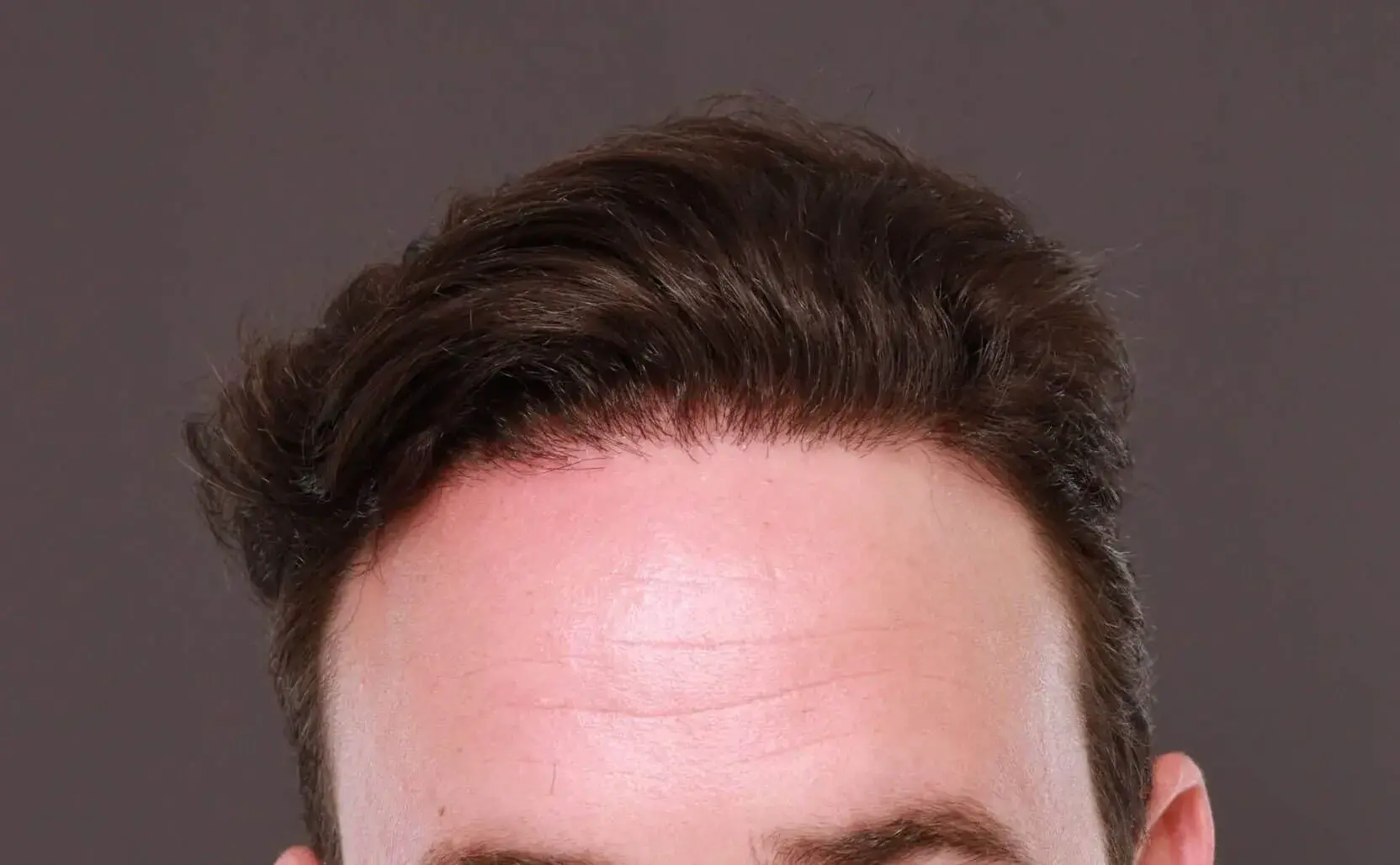 UFP Hair Restoration fue transplant after — Draper, UT