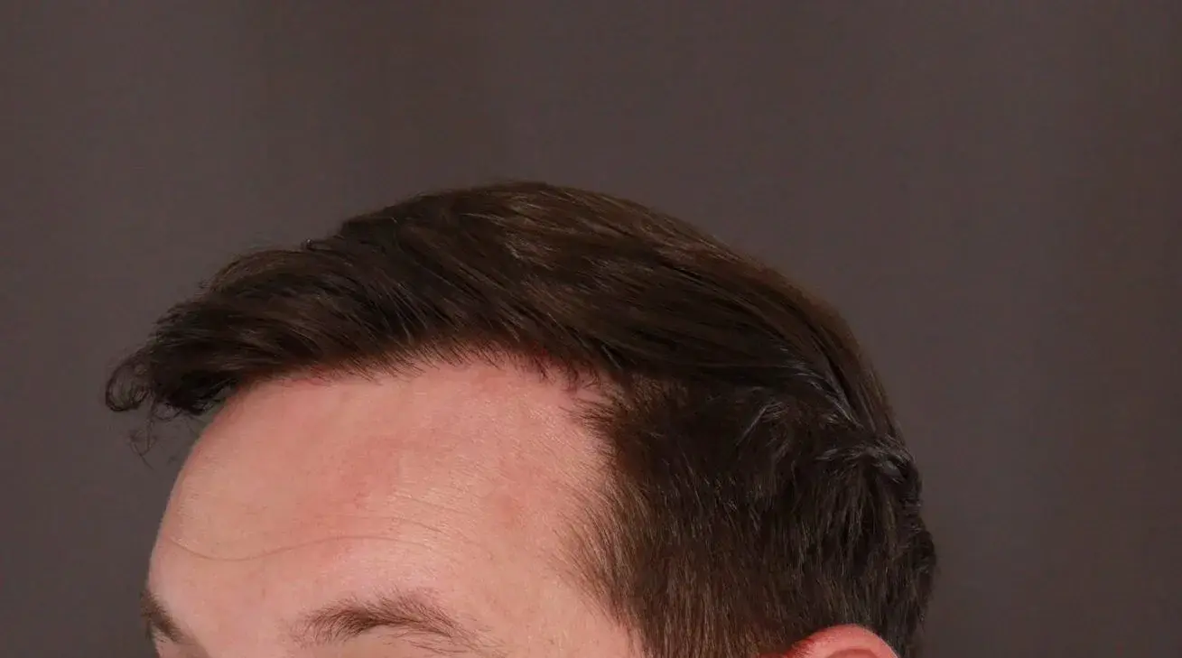 UFP Hair Restoration fue transplant after — Draper, UT