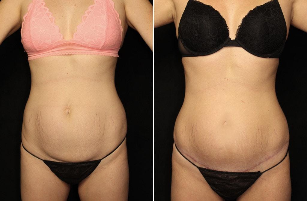 Granite Bay Cosmetic Surgery body contouring result — Granite Bay, CA