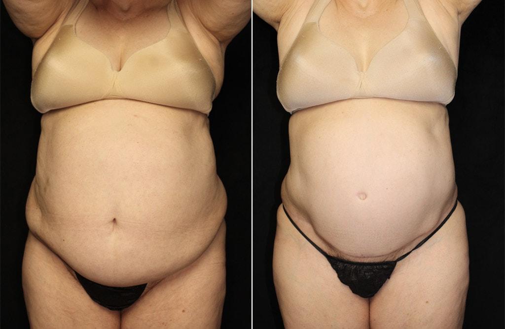 Granite Bay Cosmetic Surgery body contouring result — Granite Bay, CA